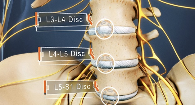 Thoát vị đĩa đệm l4l5 là bệnh gì?