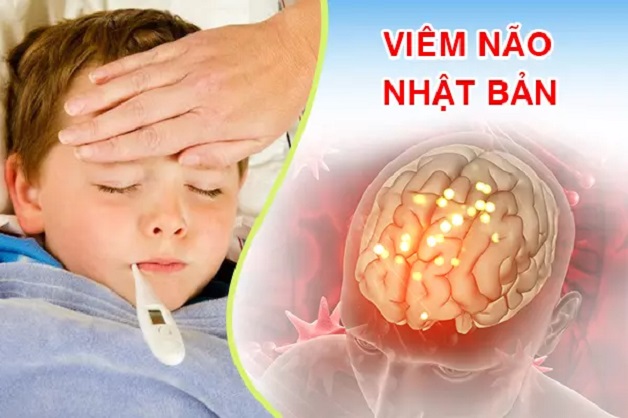 Viêm não Nhật Bản là một bệnh nhiễm trùng cấp tính do virus viêm não Nhật Bản (JEV) gây ra