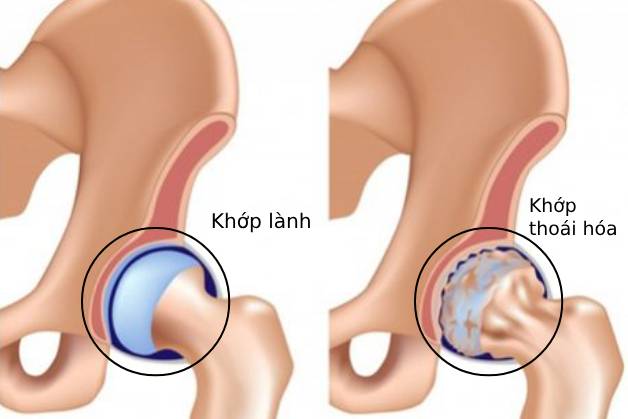 bệnh thoái hóa khớp háng