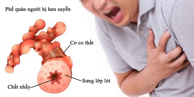 tìm hiểu bệnh hen phế quản
