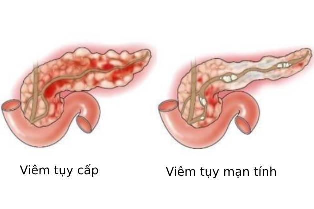 bệnh viêm tụy