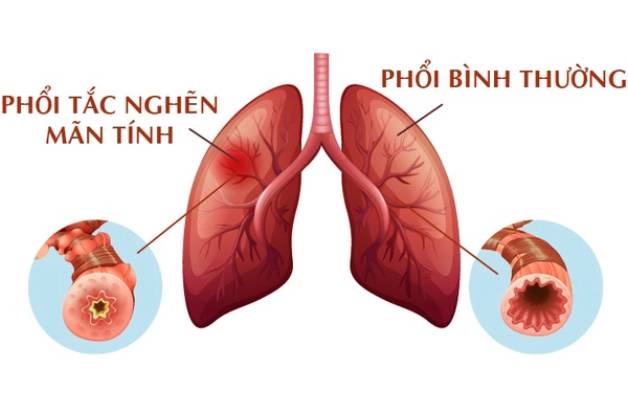 tắc nghẽn phổi mãn tính