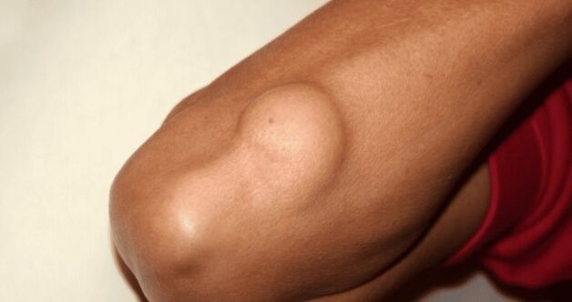 Triệu chứng và nguyên nhân của bệnh ung thư mô mỡ
