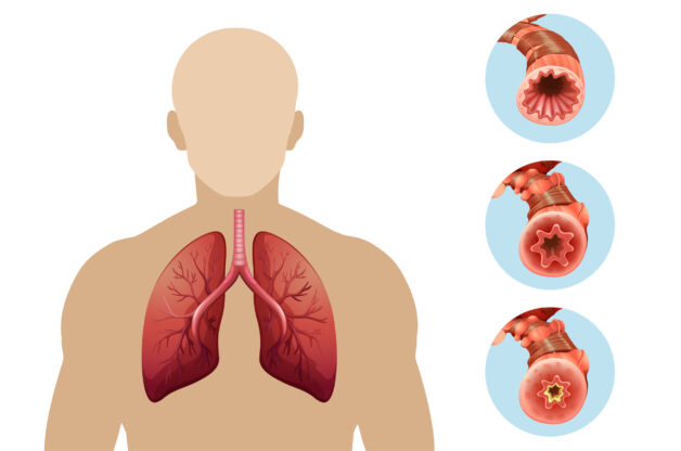 Viêm phế quản cấp tính là gì