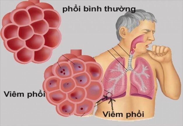 Bệnh nhân u tuyến thượng thận có thể bị suy hô hấp