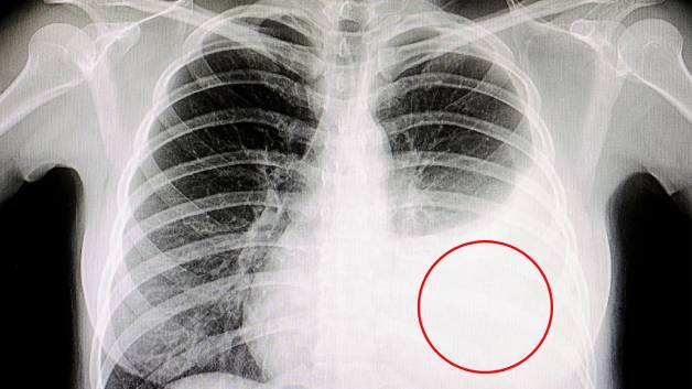 Nhận biết về ung thư màng phổi