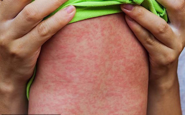 Người mắc bệnh sởi sẽ có các triệu chứng lâm sàng như sốt cao, ho, viêm mũi, viêm kết mạc mắt (mắt đỏ), tiêu chảy, nổi ban đỏ khắp cơ thể