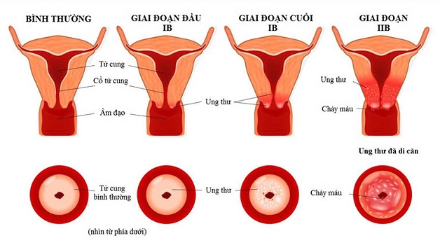 Ung thư cổ tử cung là một vấn đề sức khỏe nghiêm trọng