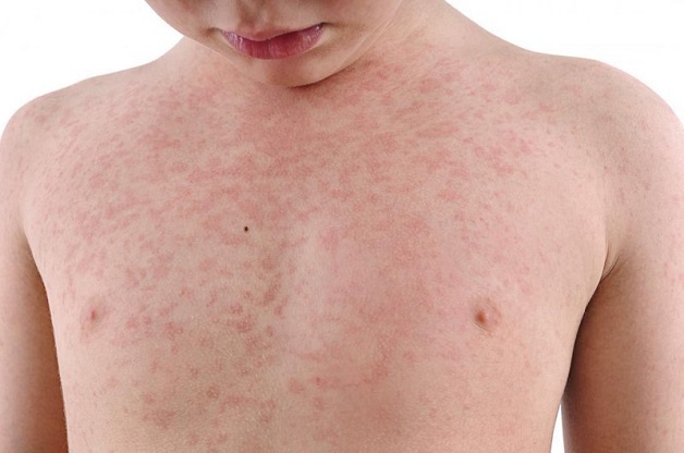 Bệnh Rubella xuất hiện với triệu chứng ban đỏ trên da kèm theo các cơn sốt