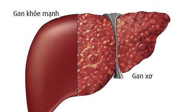 Xơ gan sẽ làm suy giảm chức năng gan và khiến lá gan không phục hồi được như trước