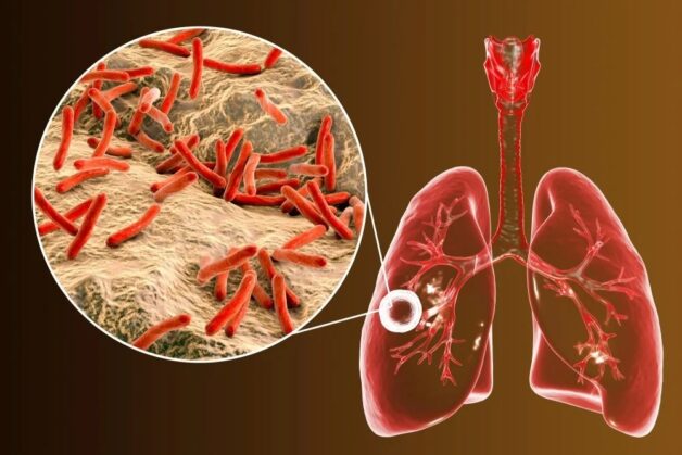 Bệnh lao phổi có chữa khỏi được không - Cách quản lý