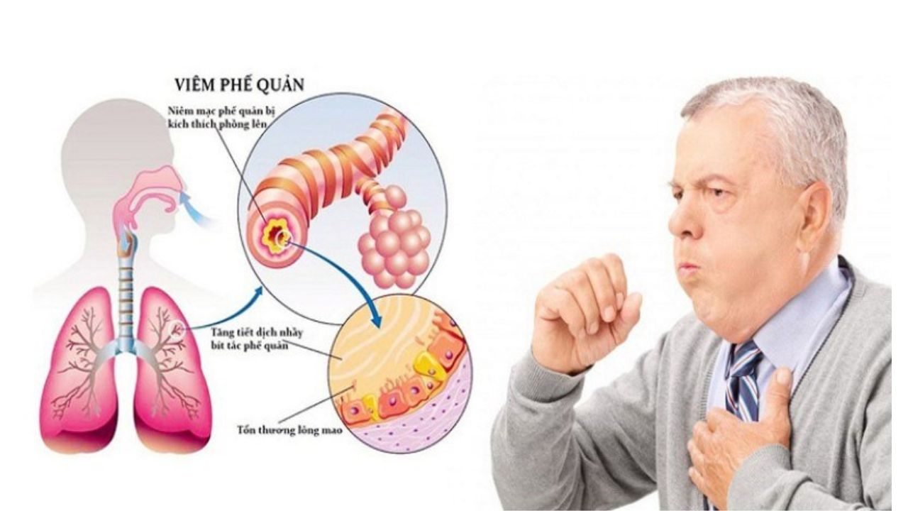 DẤU HIỆU VIÊM PHẾ QUẢN Ở NGƯỜI LỚN THƯỜNG LÀ HO KÉO DÀI KÈM ĐỜM VÀ SỐT CAO