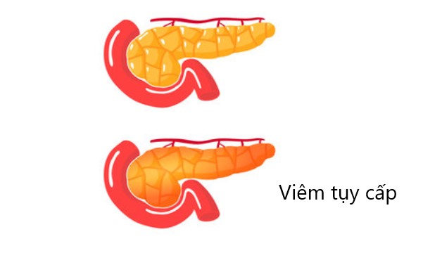 Thông tin về bệnh lý viêm tụy cấp