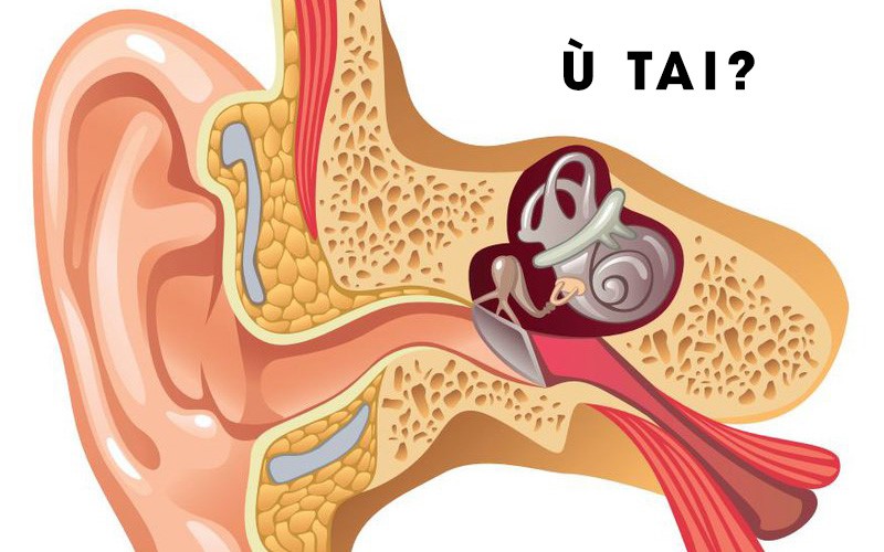 Tình trạng bị ù tai
