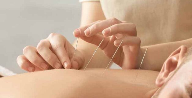 Châm cứu mất ngủ