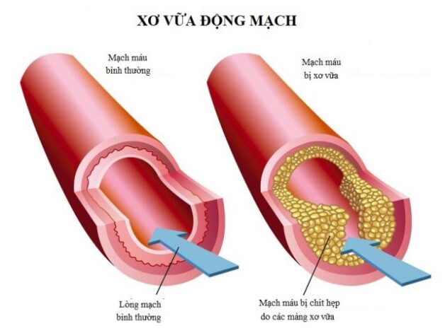 Nhồi máu cầu não do xơ vữa mạch máu lớn