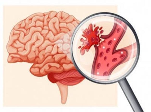 nguyên nhân gây ra tình trạng đột quỵ
