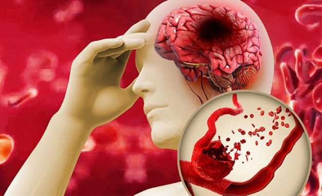 Cần nhận biết sớm biểu hiện của đột quỵ để dự phòng bệnh