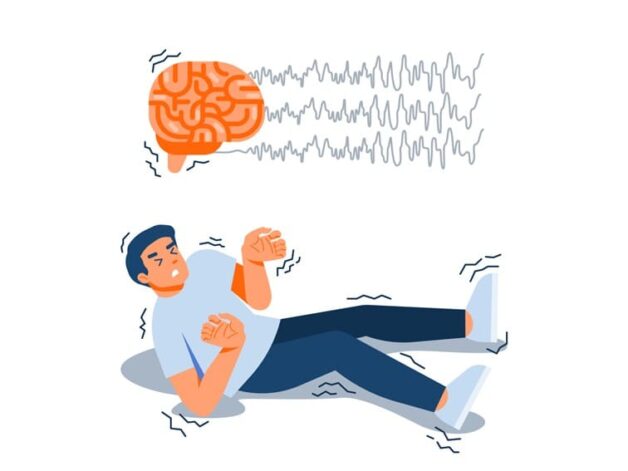 Nguyên nhân gây bệnh động kinh và triệu chứng