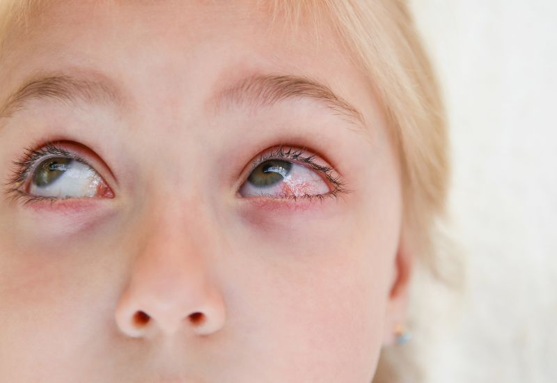 Do nở mạch máu và tăng tiết dịch, mắt thường sưng, đỏ khi đau mắt đỏ.