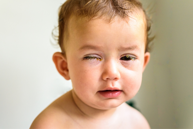 Một người có thể phỏng đoán sự tồn tại của đau mắt đỏ ở bản thân nếu có các triệu chứng như mắt sưng, đỏ, mắt ngứa, mắt đau nhức, mắt tăng tiết nước mắt và tăng tiết dịch, mắt nhạy cảm với ánh sáng, xuất hiện giả mạc – màng mỏng, đục, bao phủ mặt trong mí mắt.