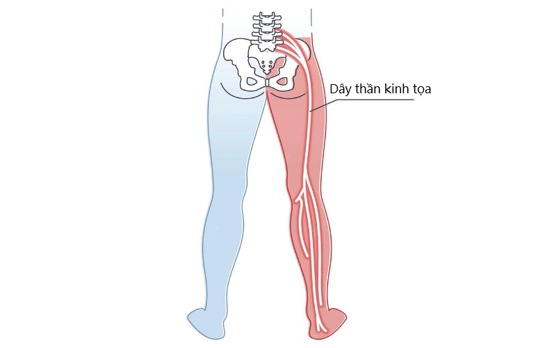 Đau thần kinh tọa xảy ra như thế nào?