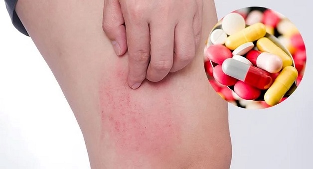 Dị ứng kháng sinh có thể gây ra phát ban khi sử dụng kháng sinh