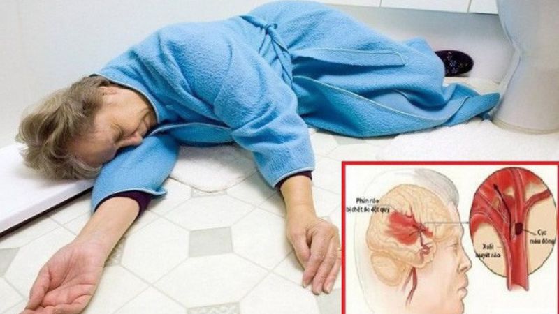 phương pháp sơ cứu chữa đột quỵ