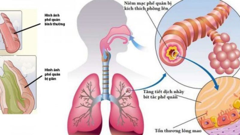 Tiên lượng của bệnh nhân giãn phế quản