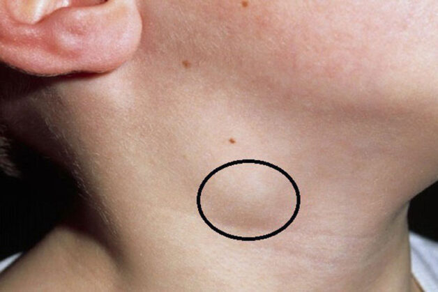 mức độ lây của bệnh lao hạch