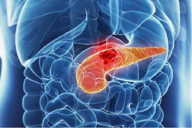 Những điều cần biết về dấu hiệu viêm tụy cấp để bảo vệ sức khỏe
