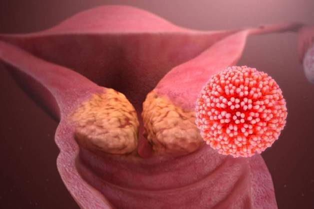 Mối liên hệ giữa virus HPV và căn bệnh ung thư cổ tử cung