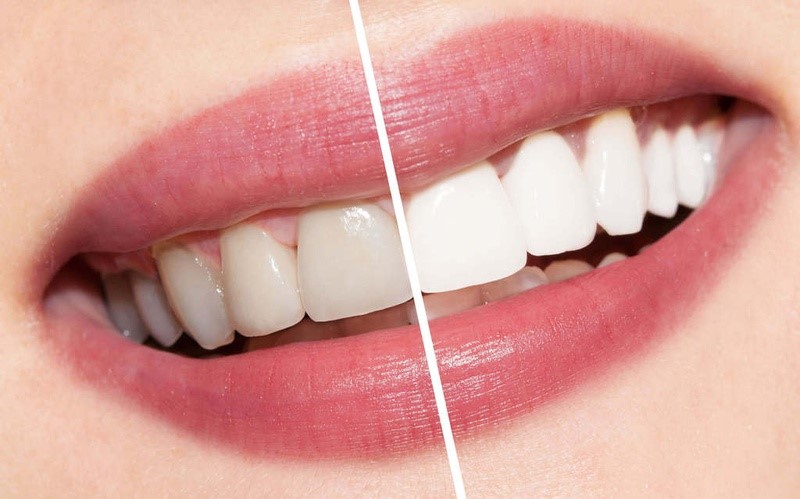Thực hiện tẩy trắng răng có gây hại không