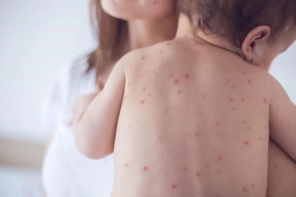 Bệnh thủy đậu có thể lây lan khá nhanh chóng.