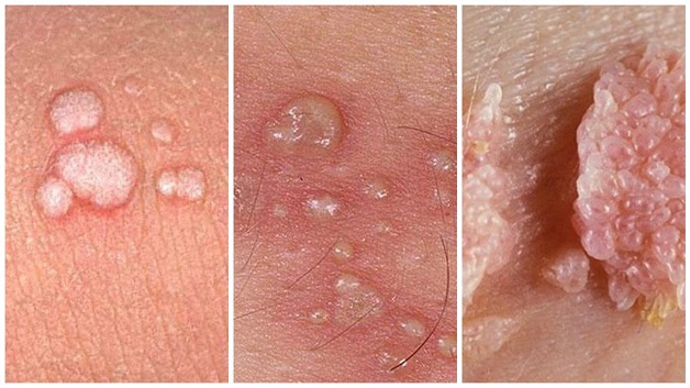 Mụn cóc sinh dục hay sùi mào gà do HPV xuất hiện ở cả nam giới và nữ giới có thể ngăn chặn bằng việc tiêm vacxin HPV