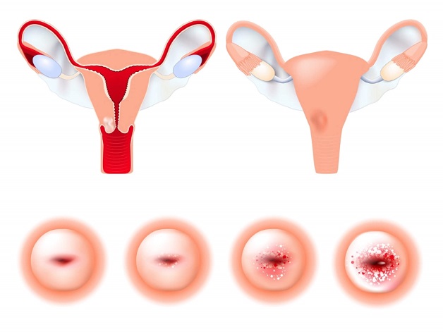 Ung thư cổ tử cung, một trong những bệnh lý ác tính và phổ biến nhất do HPV gây ra, có thể ngăn chặn hoàn toàn bằng cách tiêm vacxin HPV