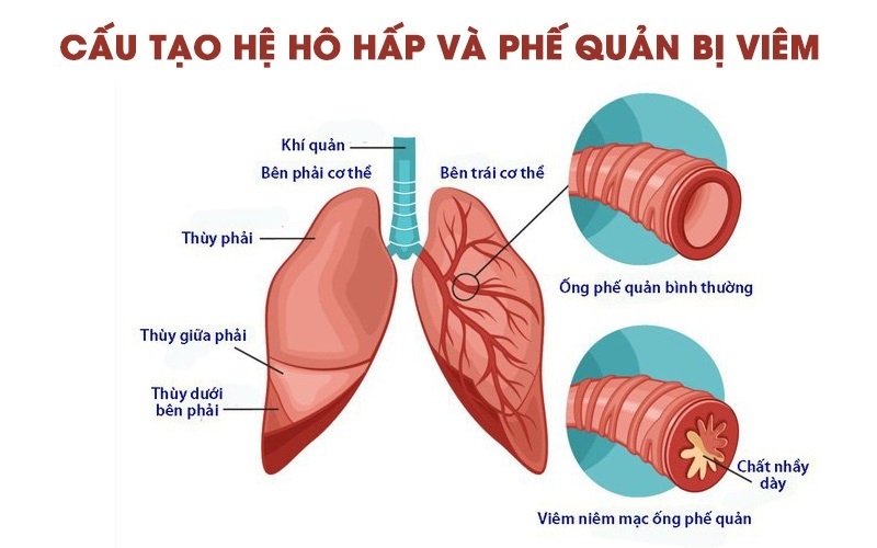 bệnh viêm phế quản