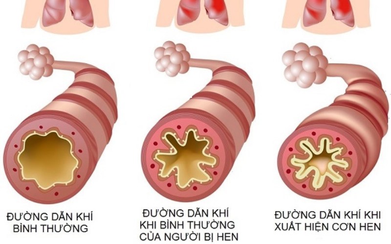 bệnh hen phế quản cấp