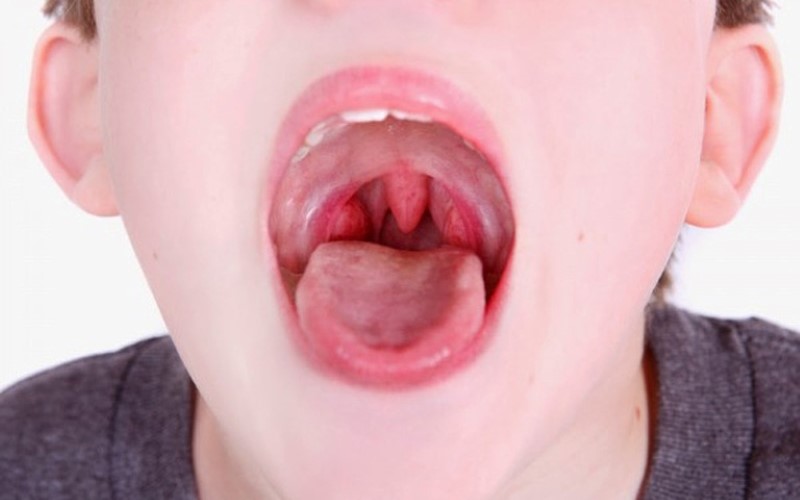 Trẻ bị sốt viêm amidan