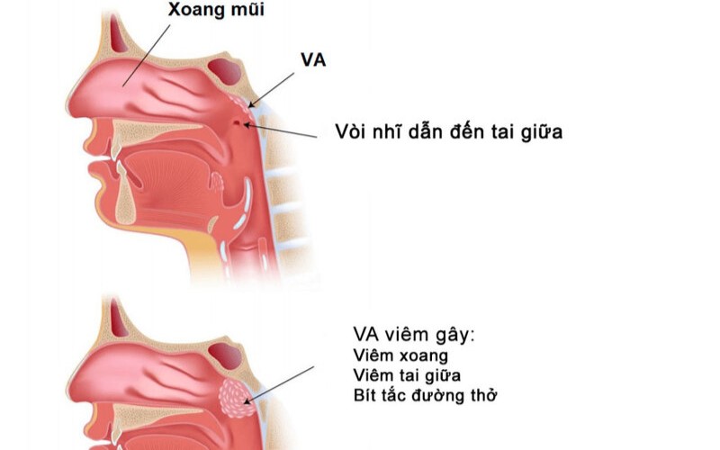 viêm VA