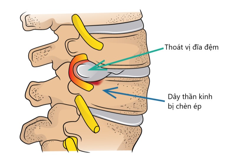 Triệu chứng của thoát vị đĩa đệm đốt sống L3, L4