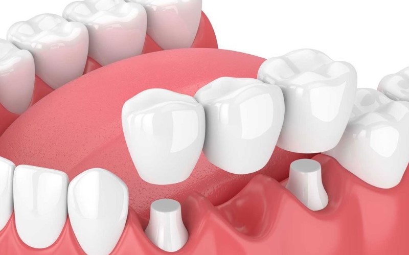 Tìm hiểu trồng răng sứ có đau không