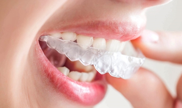 Tư vấn niềng răng