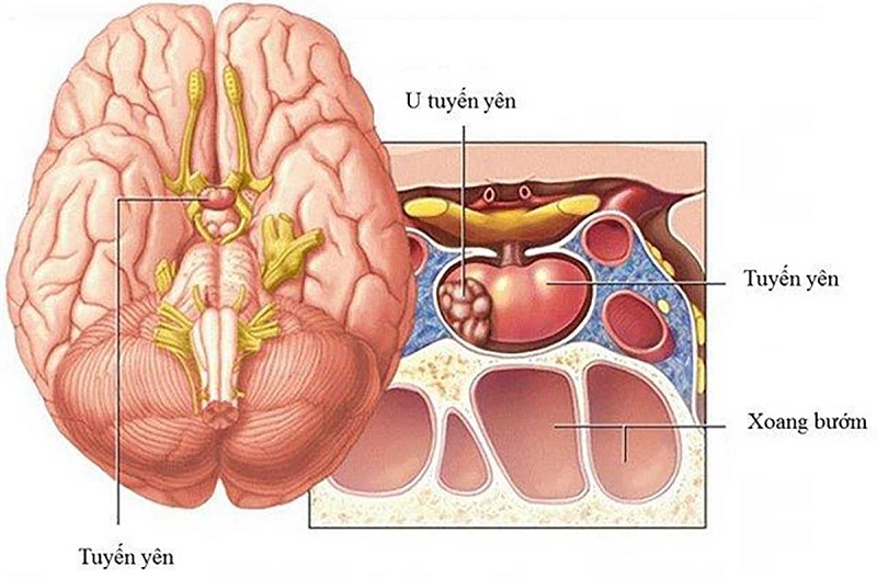 Các bệnh lý liên quan đến rối loạn hormone tuyến yên