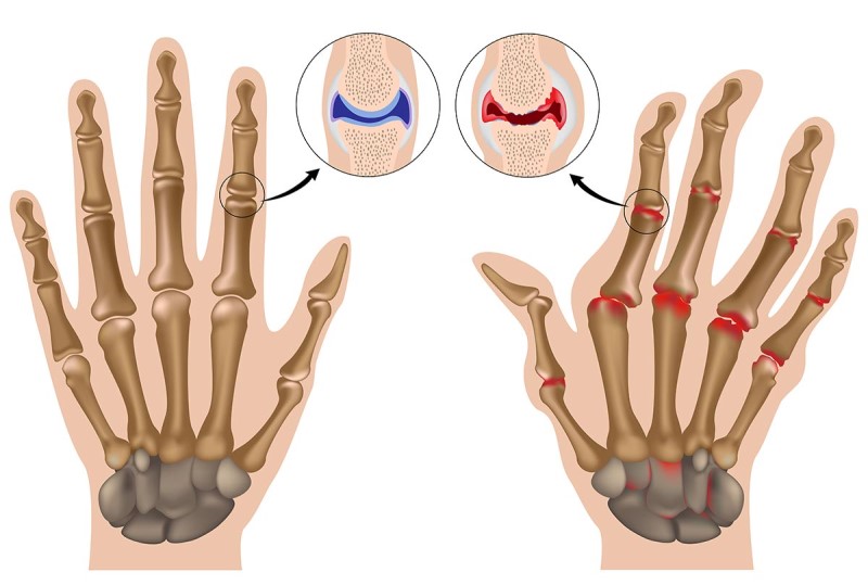 Mục tiêu điều trị cho bệnh nhân viêm khớp dạng thấp