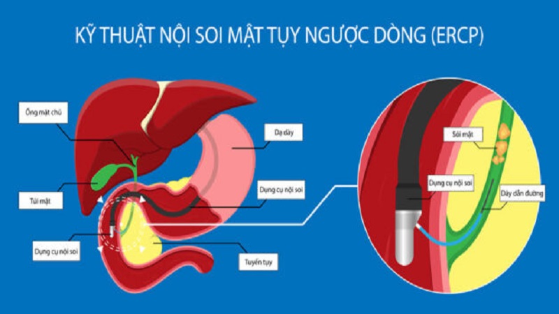 Kỹ thuật nội soi mật tụy ngược dòng