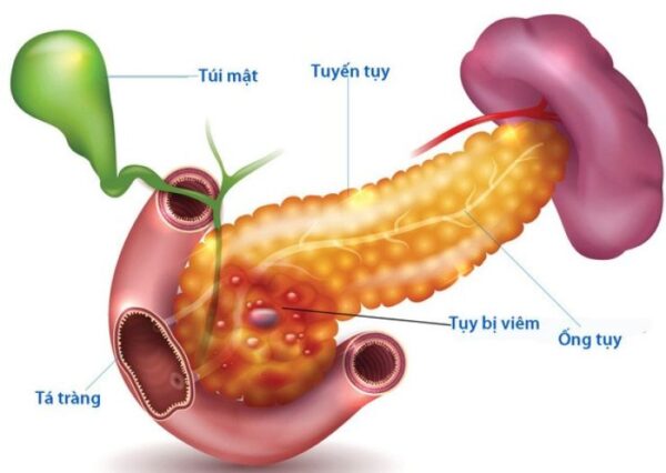 Viêm tụy cấp thể hoại tử