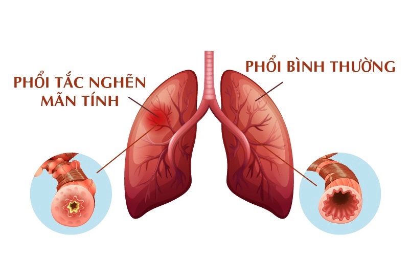 Bệnh Phổi tắc nghẽn mạn tính có thể khiến tính mạng người bệnh gặp nguy hiểm.