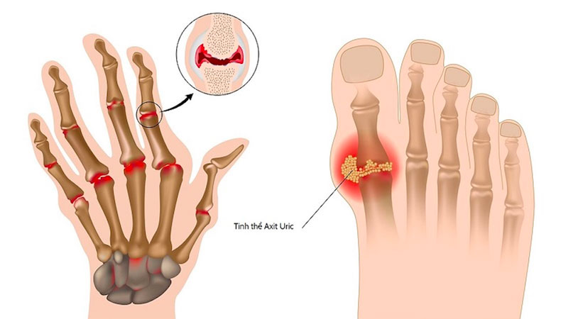 Gout là bệnh gì?