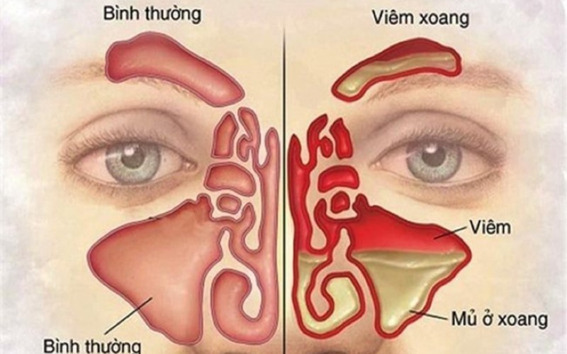 Viêm xoang